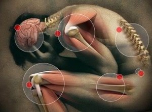 Una mappa dei punti del corpo dove spesso si prova dolore cronico